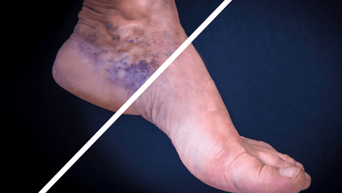 Understanding Venous Insufficiency and Varicose Veins